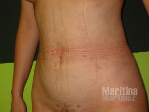 Liposucción de abdomen: ¿con o sin abdominoplastia? - Clínica