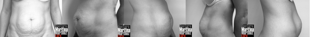 Caso cirugía tras el embarazo (pecho)