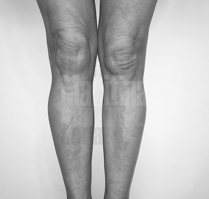 Casos de liposucción en piernas