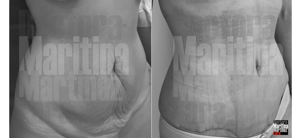 Caso1 abdominoplastia medio perfil montajemarca
