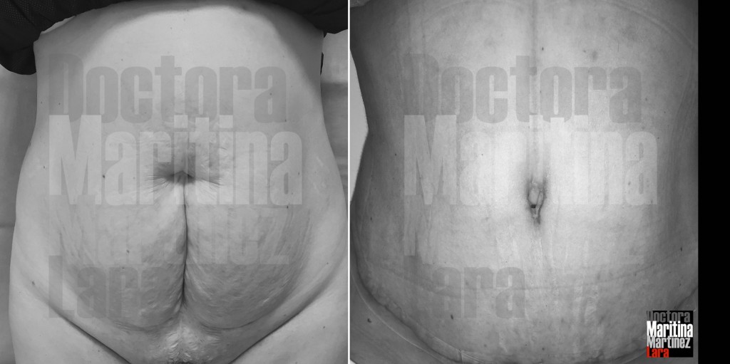 Caso2 abdominoplastia frente