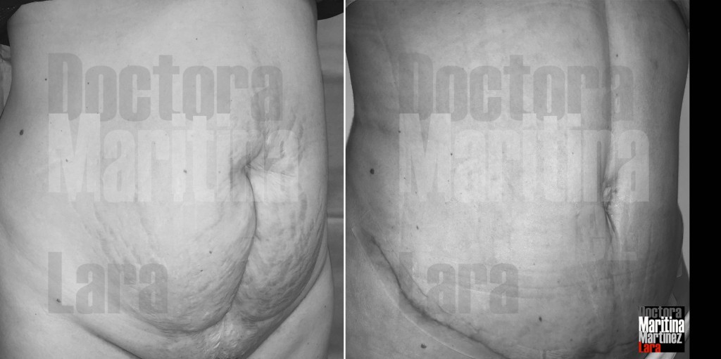 Caso2 abdominoplastia medio perfil D