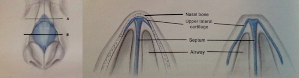 Esquema del dorso nasal y sección de la bóveda nasal alta y media