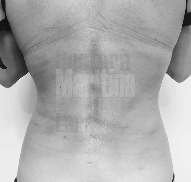 Caso clínico: Liposucción de espalda
