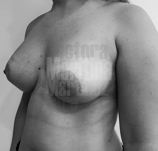 Caso clínico: Corrección de mamas tuberosas muy malformadas con implantes anatómicos y pexia periareolar