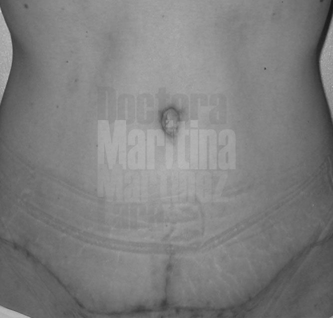 Abdominoplastia modificada con pequeña cicatriz vertical