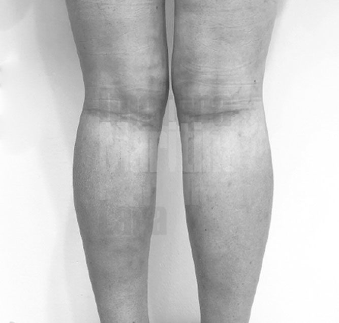 Caso clínico: Aumento de gemelos con prótesis e injertos de grasa