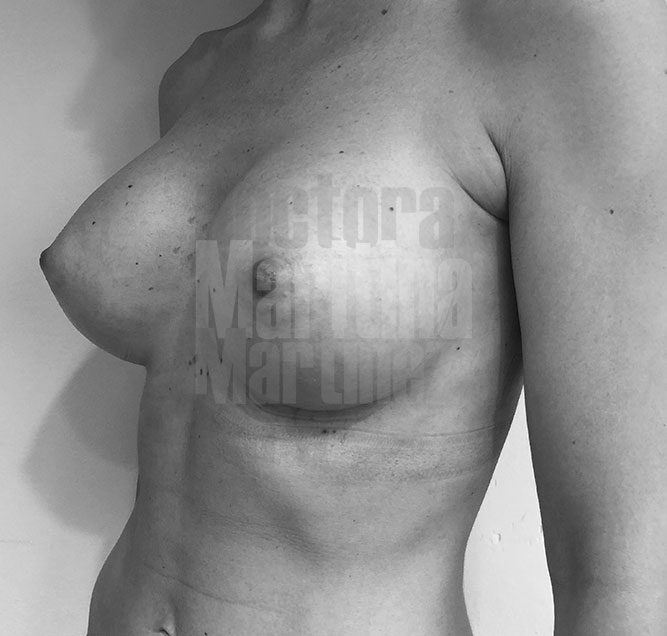 Caso clínico: Aumento mamario con implantes anatómicos en paciente muy delgada y pseudoptosis