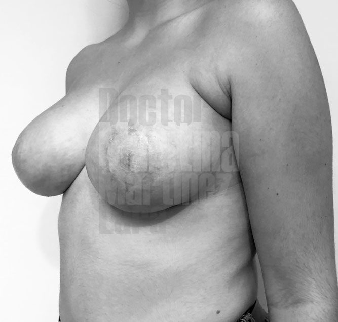 Casos difíciles de mamas tuberosas: cuando hay que asociar muchas técnicas