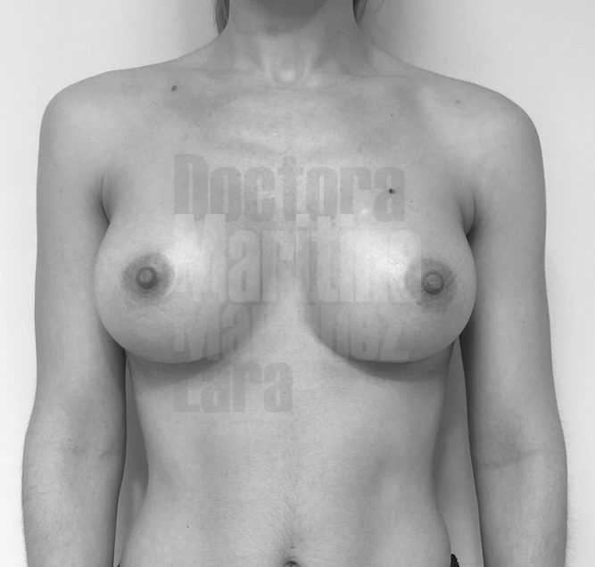 Cirugía mamaria secundaria para tratar contractura, rotura y malposición