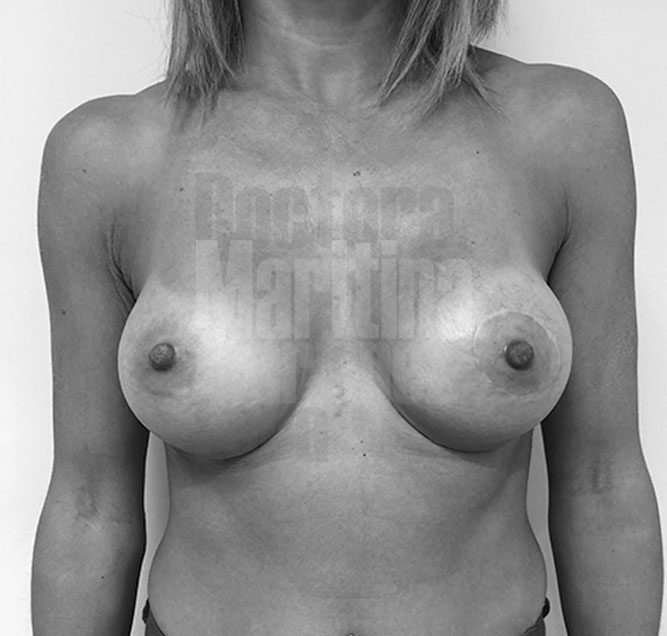 Caso clínico: corrección de asimetría mamaria y pseudoptosis