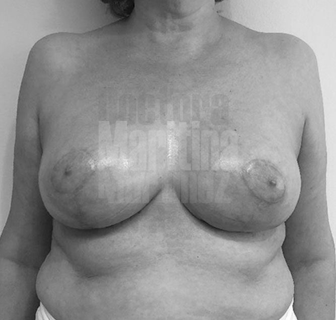 Caso clínico: Evolución de reducción mamaria