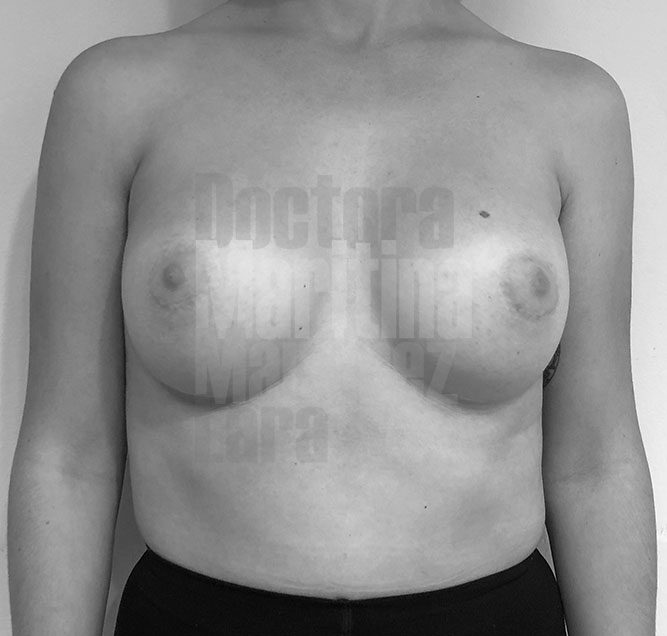 Caso clínico: evolución de aplasia mamaria tras aumento con implantes anatómicos