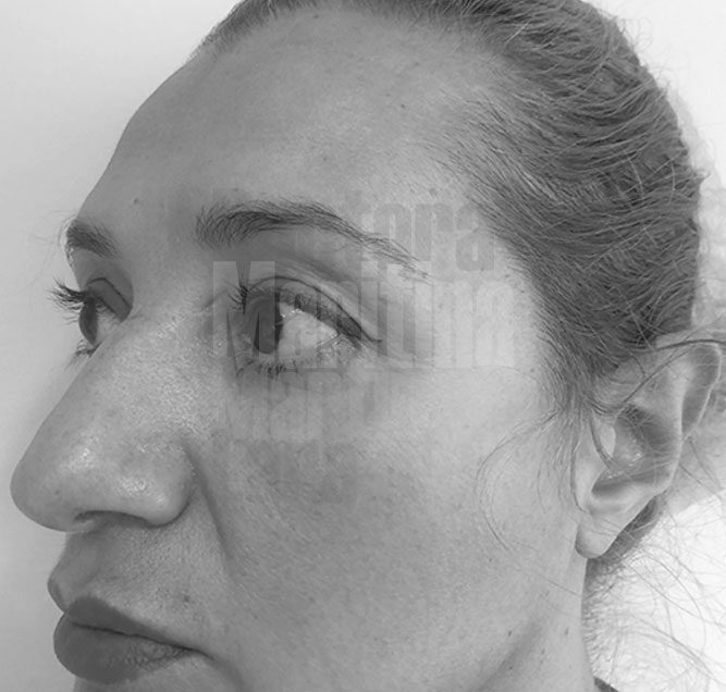 Caso clínico:  Blefaroplastia de párpados inferiores asociada a lipofilling en ojera y surco infraorbitario