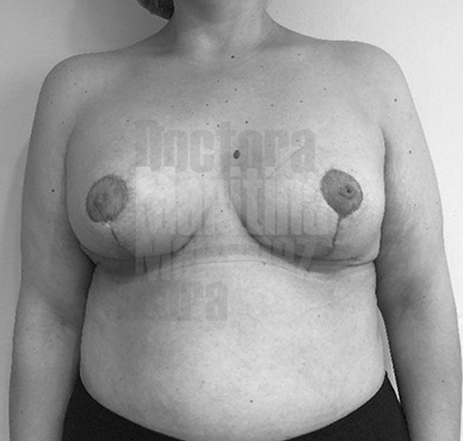 Caso clínico: Combinación de varias técnicas en un caso complejo de ptosis y asimetría en mamas malformadas