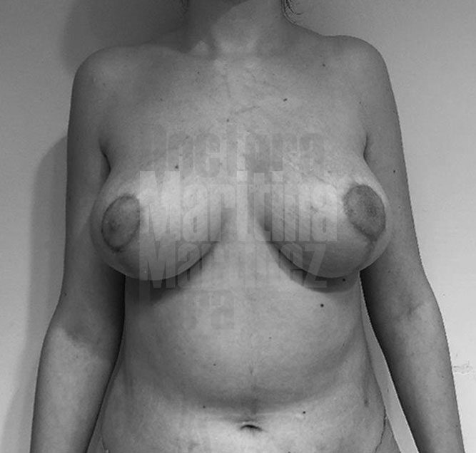 Caso clínico: Aumento mamario mixto con implantes y lipofilling