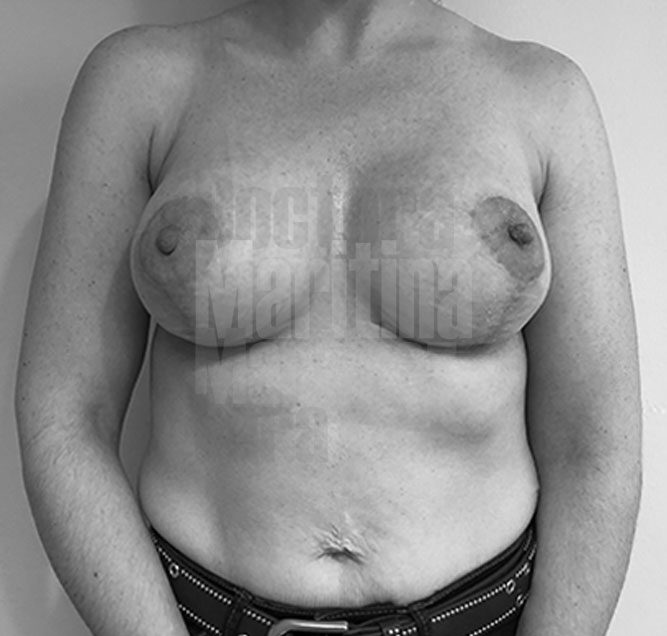 Caso clínico: Corrección de asimetría mamaria con mastopexia