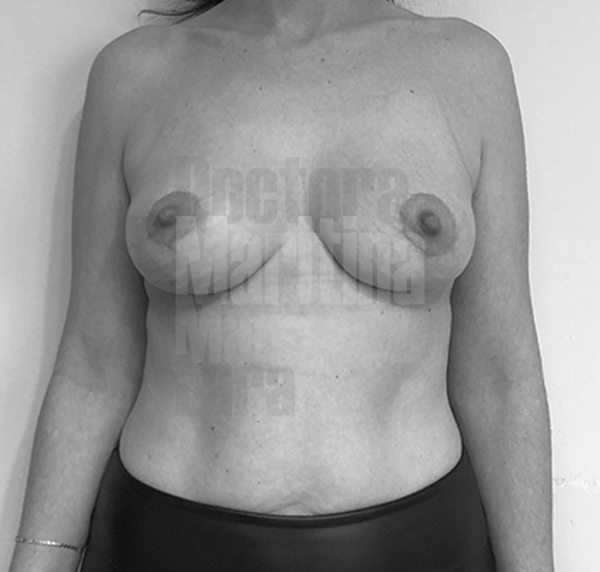 Caso clínico: Reducción mamaria