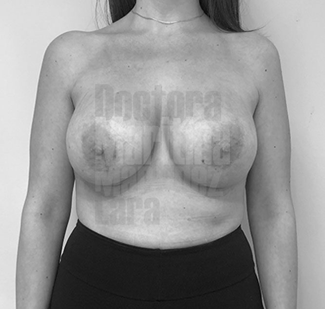 Caso clínico: Aumento mamario híbrido con implantes y lipofilling