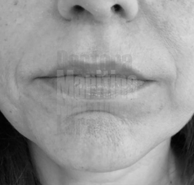 Caso clínico: Lip Lift para reducir unos labios muy alargados