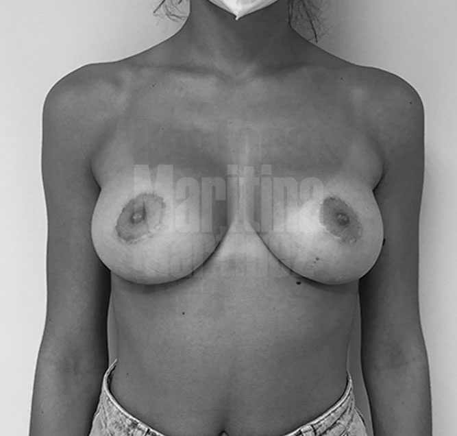 Caso clínico: Reducción mamaria en paciente joven