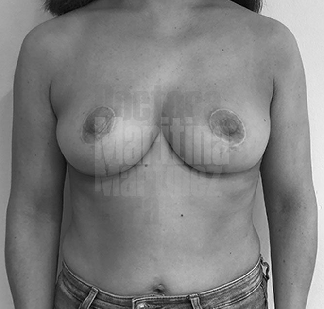 Caso clínico: Reducción mamaria y corrección de leve asimetría