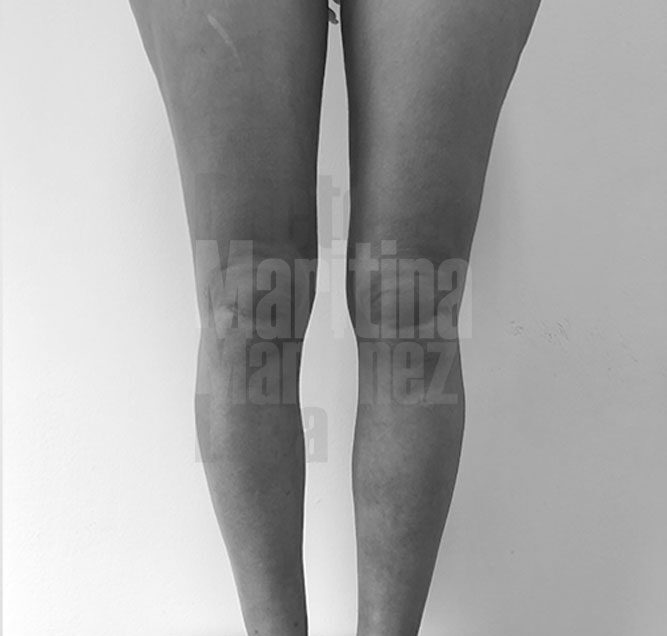Caso clínico: Lipedema tipo 3 estadío I en muslos, rodillas y tobillos