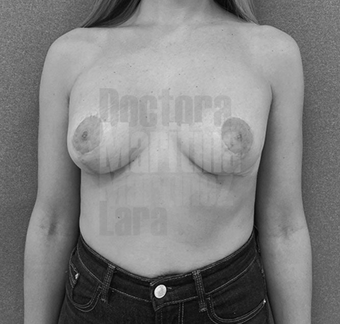 Caso clínico: Mastopexia para corregir ptosis en mamas tuberosas de tamaño normal, planteado como reducción y aumento con implantes