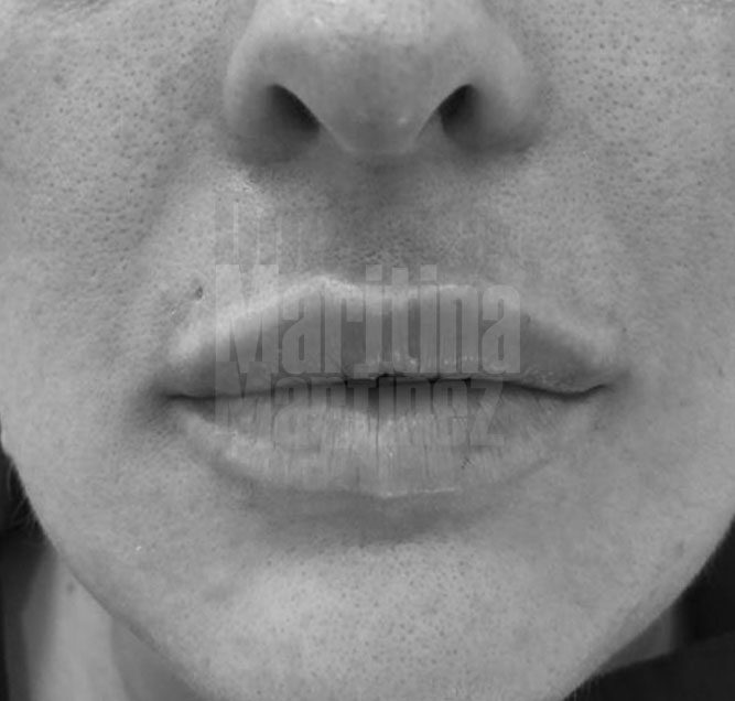 Caso clínico: Aumento de labios con ácido hialurónico
