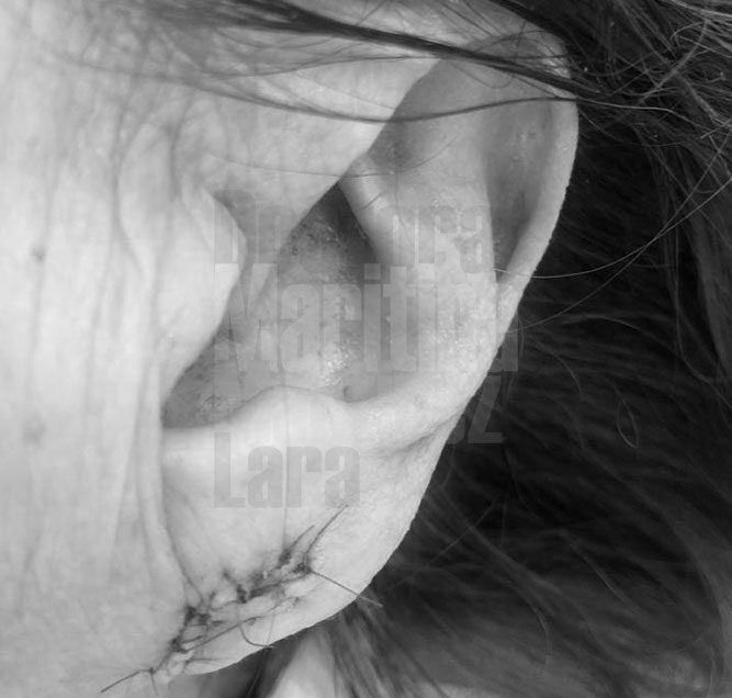 Caso clínico: Reparación del lóbulo auricular