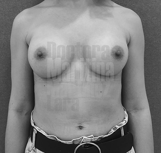 Caso clínico: Hipoplasia mamaria involutiva