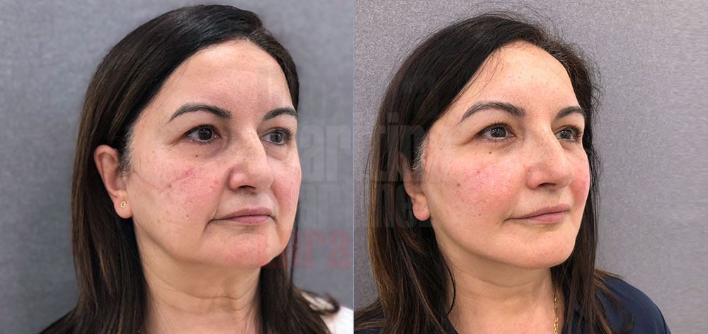 Caso clínico: Lifting facial profundo para mejorar contorno facial y  cervical