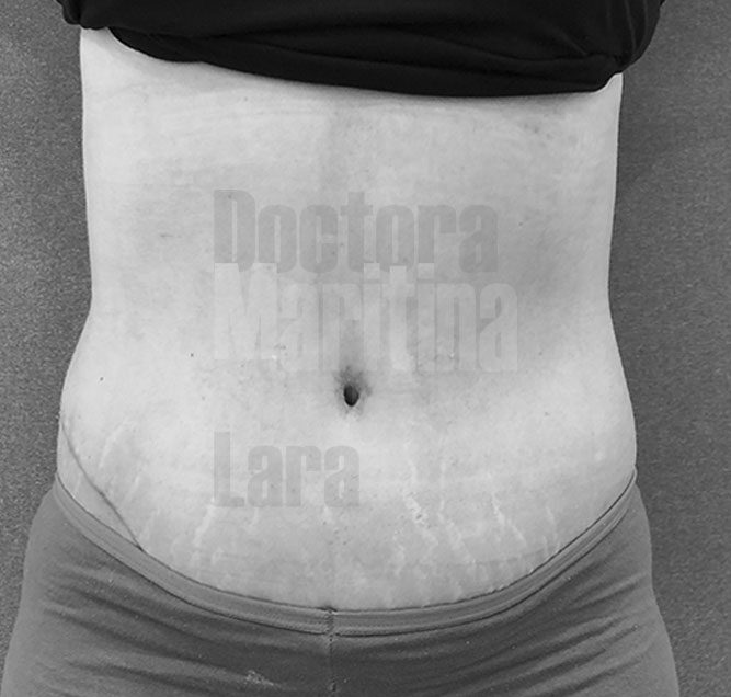 Caso clínico: Abdominoplastia extendida tras embarazos y pérdida de peso
