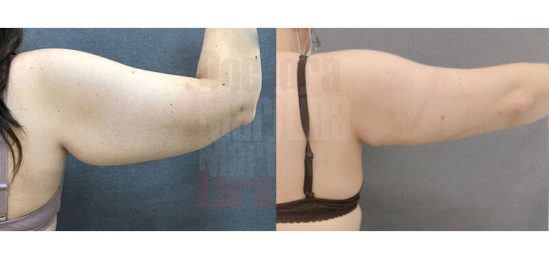 liposucción-espalda-2