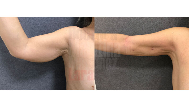 liposucción-brazo-1