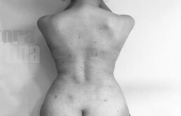 Caso clínico de liposucción de espalda