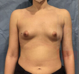 Caso clínico corrección de mamas tuberosas tipo 2