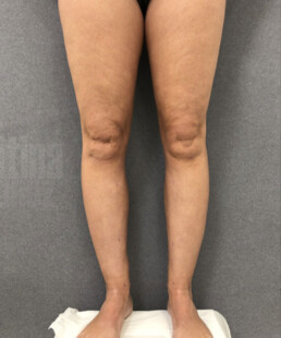 Caso clínico de liposucción en tobillos, piernas y rodillas.