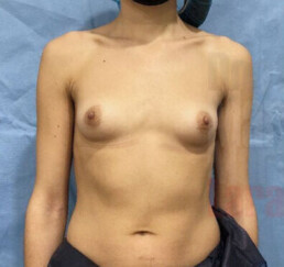 Caso clínico de mamas tuberosas muy atróficas en tórax corto y asimétrico