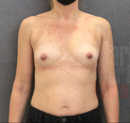 hipoplasia mamaria de mamas tuberosas tipo 2